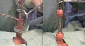 Circumcision-Procedure-300x164.jpg Circumcision-Procedure-300x164.jpg