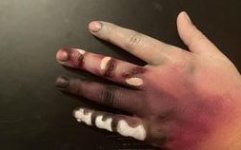 hand_apparently_shows_various_stages_of_decomposition.jpg hand_apparently_shows_various_stages_of_decomposition.jpg